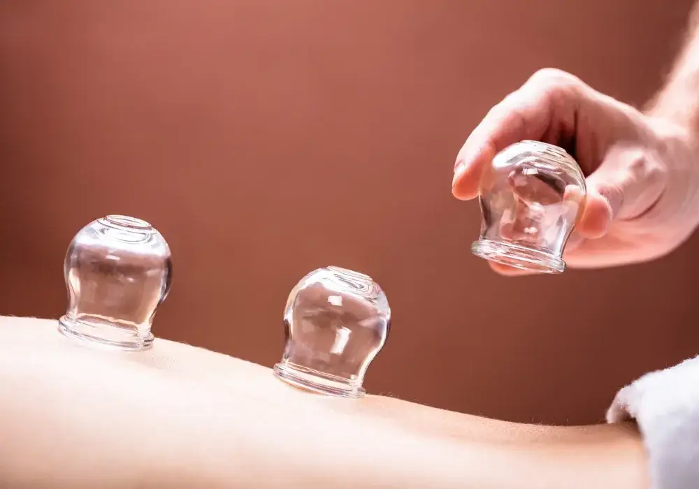 Glass cups placed along a patient's back during a cupping treatment