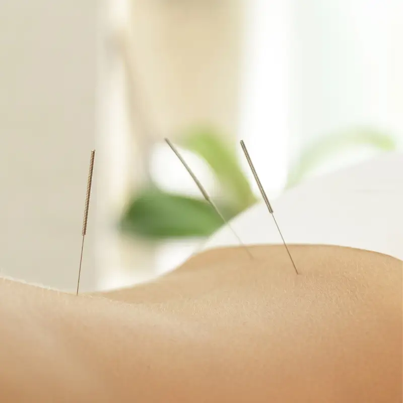 Chiropractor Melbourne applying dry needling to lower back muscle