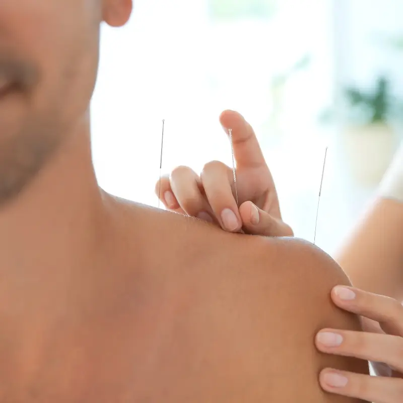 Chiropractor Melbourne applying dry needling to shoulder muscles