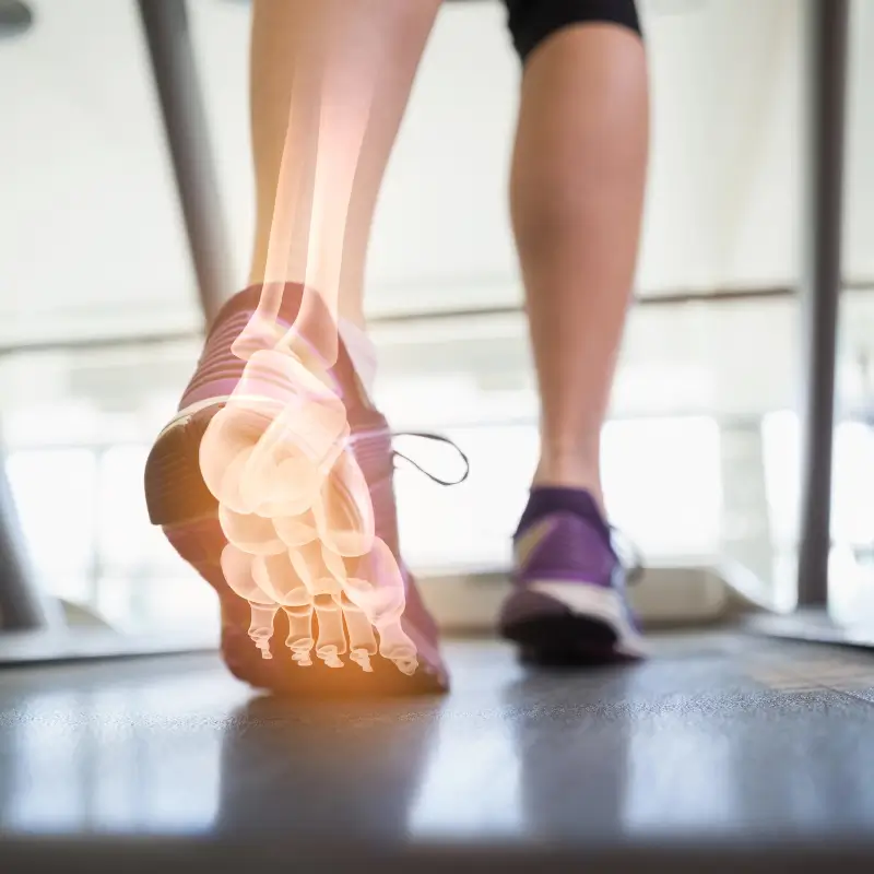 Chiropractor Melbourne – Digital overlay of foot bones during treadmill walking showing plantar fasciitis